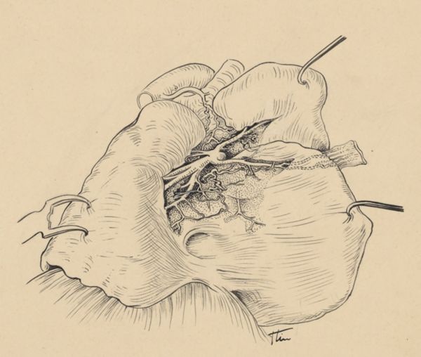 J Tinkelenberg, Part of the heart and circulatory system