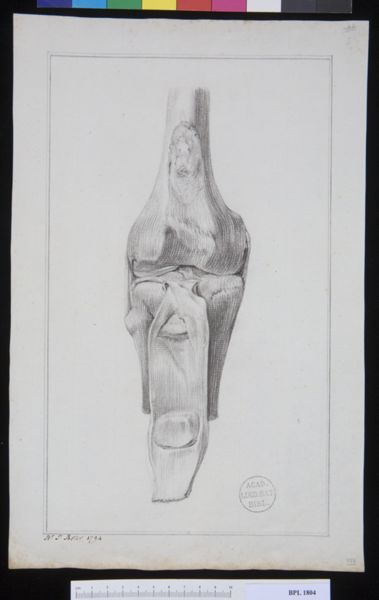 Poster, H.J, (active, Pathology, fractures (Patella)