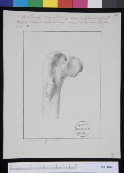 M Houtman, Pathology, fractures (Femur)