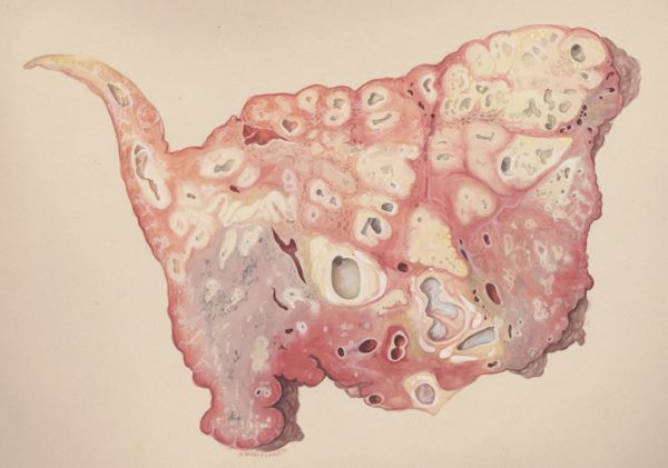 J Wetselaar-Whittaker, Lung tissue