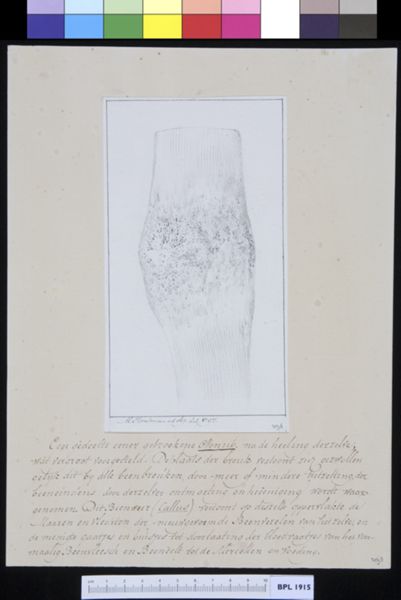 M Houtman, Healed fracture of a rib