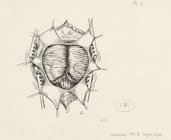 J Tinkelenberg, Neurosurgical Procedures