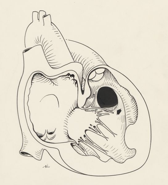 J Tinkelenberg, Heart