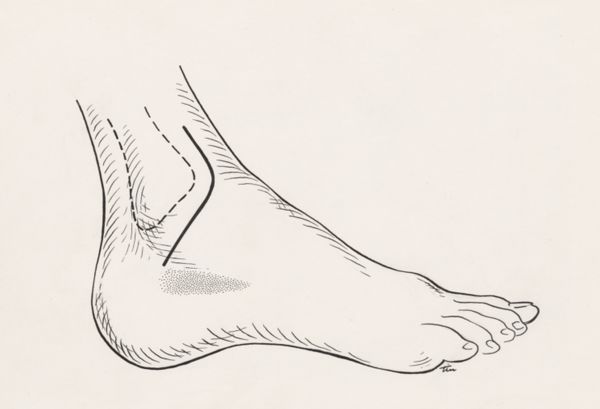 J Tinkelenberg, Surgery of the ankle ligament
