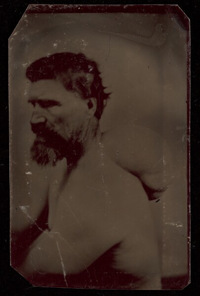 Unknown, [Portrait of a Bearded Man with Abnormal Growth on Back]