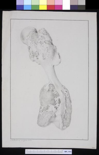 M Houtman, Pathology, fractures (Femur)