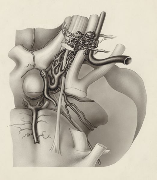 J Tinkelenberg, Nerves and other tissue of the neck and/or head