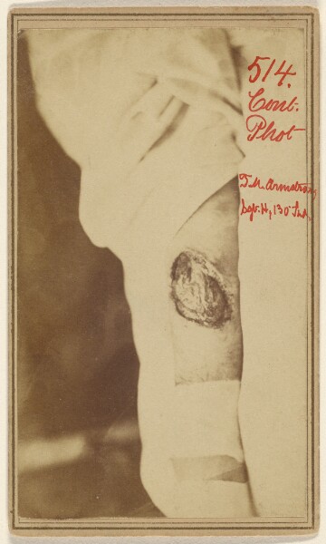 Unknown, [Leg wound of Thomas M. Armstrong, Civil War victim]