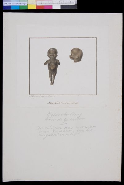 M Houtman, Foetus of a child from Suriname