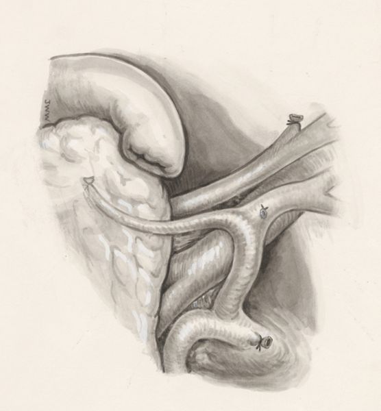 J Wetselaar-Whittaker, Surgery on a part of the human body