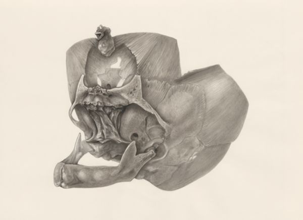 H.G Wetselaar, Deformed jawbone