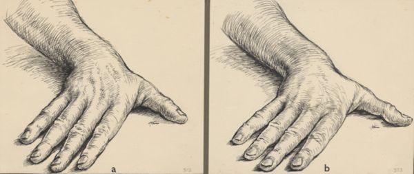 J Tinkelenberg, Two studies of the hand of dr. Landsmeer