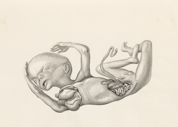 J Wetselaar-Whittaker, Fetus with open abdominal cavity