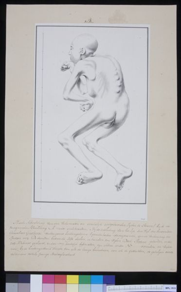 Cornelis Pronk, Man with torsioned vertebrae