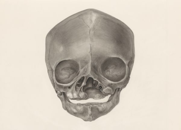 H.G Wetselaar, Deformed fetal skull