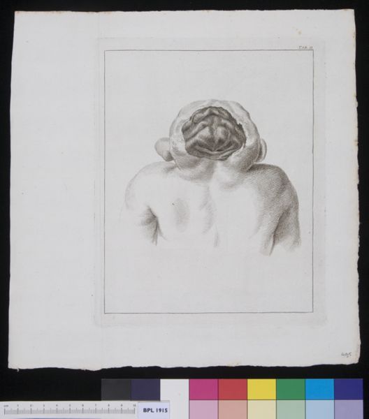 R Muys, Child with deformed head, rear view
