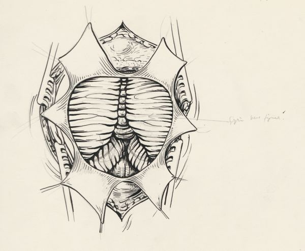 J Tinkelenberg, Neurosurgical Procedures