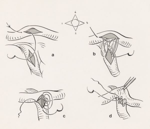 J Tinkelenberg, Thorax surgery