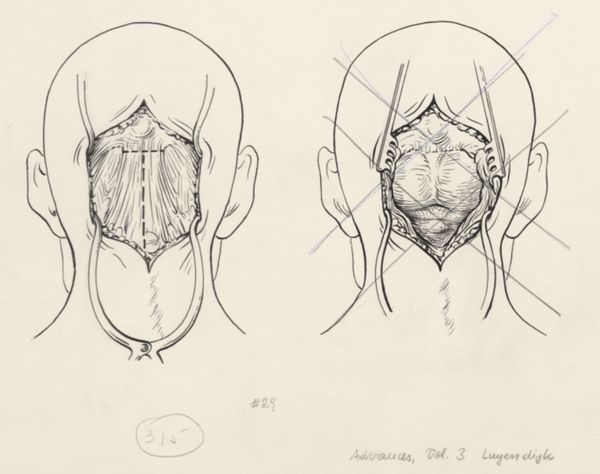 J Tinkelenberg, Neurosurgical Procedures