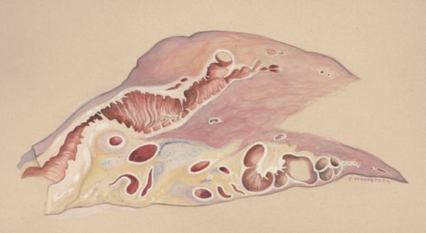 J Wetselaar-Whittaker, Lung tissue