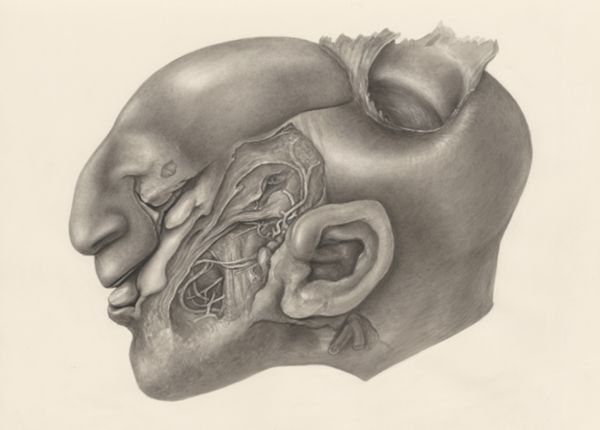 H.G Wetselaar, Deformed fetal head