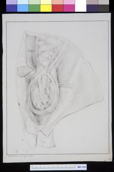 M Houtman, Inguinal hernia
