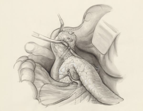 J Wetselaar-Whittaker, Part of the human body, opened with medical clamps