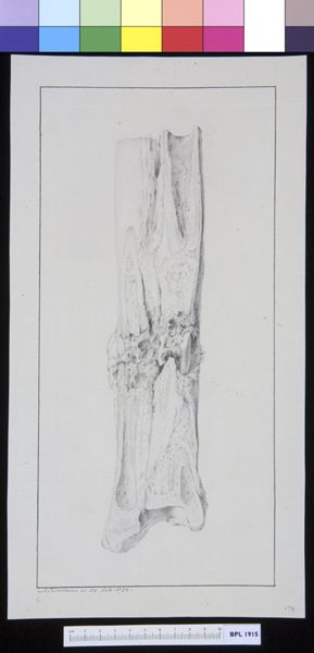 M Houtman, Infected bone